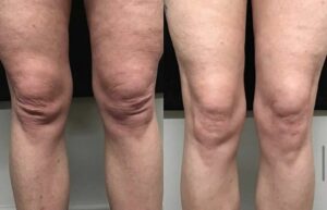 "Agora eu consigo viver sem as dores e inchaços, graças a esse spray milagroso!"